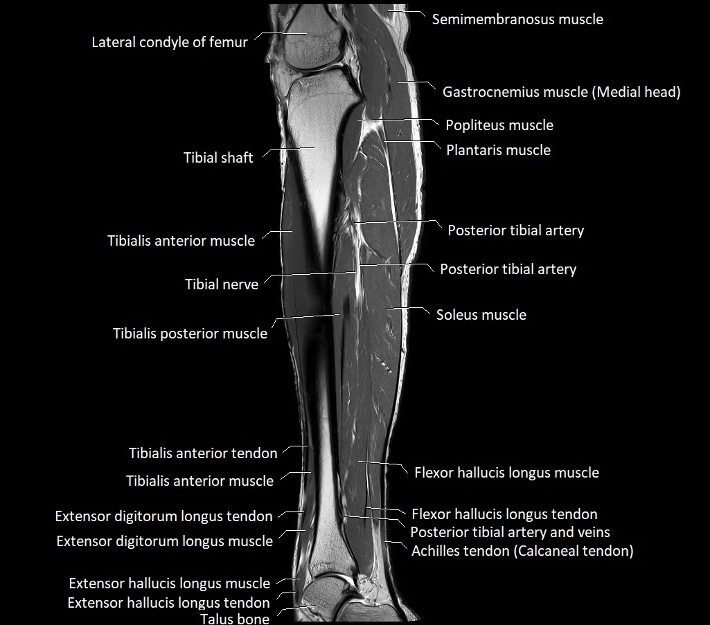 Lower leg sagittal anatomy 3T MRI image 17.webp